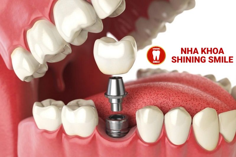 Quy Trình Trồng Răng Implant - Giải Pháp Hoàn Hảo Cho Nụ Cười Tự Tin