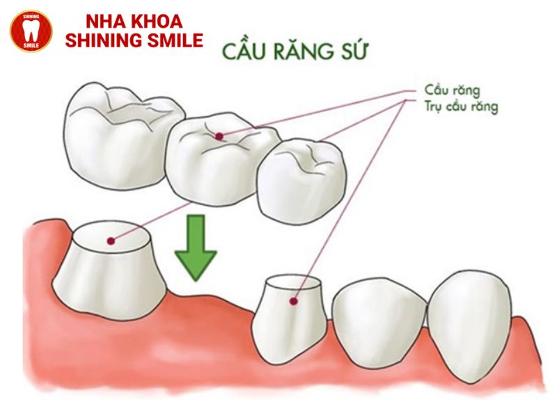 Hiệu Quả Và Ưu Nhược Điểm Khi Làm Cầu Răng Sứ - Những Điều Bạn Cần Biết