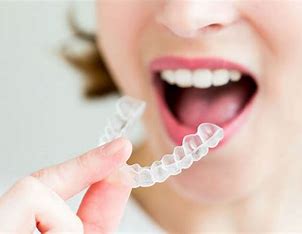 Bảng giá chi tiết 2024 Niềng răng trong suốt