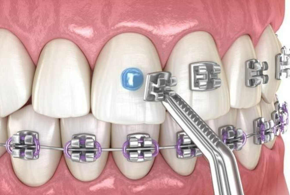 Niềng Răng Mắc Cài Kim Loại Có Đau Không? Giải Đáp Từ Chuyên Gia