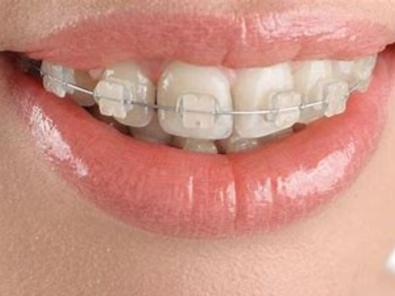 Thời gian niềng răng để đạt hiệu quả là bao lâu?