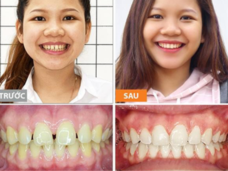 Trước và sau khi niềng răng: Sự khác biệt rõ rệt