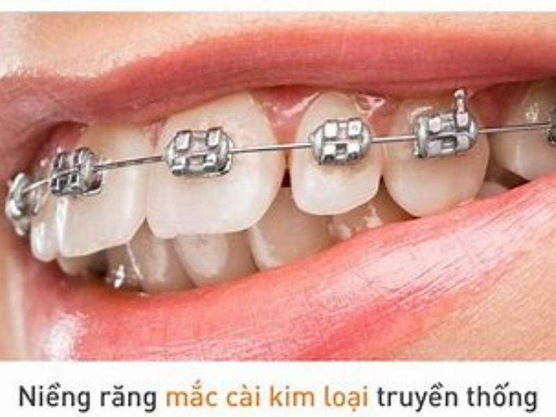 Những thắc mắc thường gặp về niềng răng hô