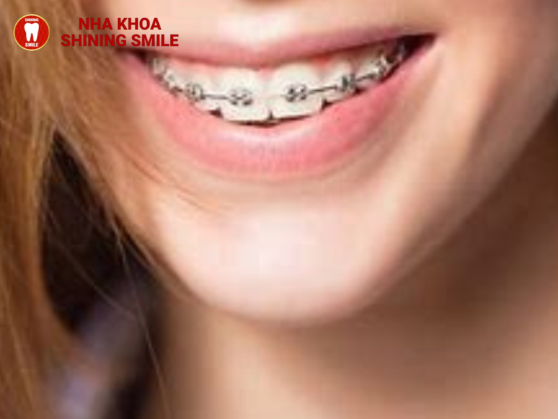 Thông tin từ A-Z mắc cài tự buộc