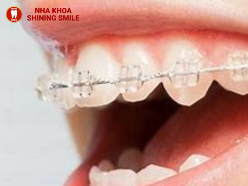 Niềng răng cho trẻ em cần lưu ý những gì?