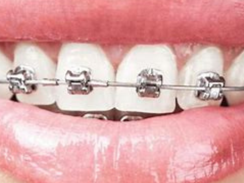 Niềng răng có đau không? Giảm đau khi niềng răng