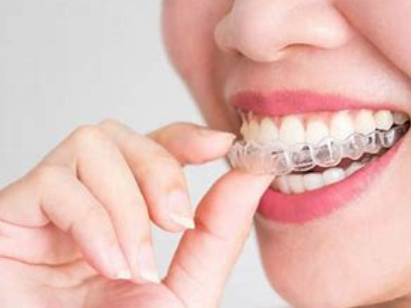 Niềng răng không mắc cài là gì? Ưu và nhược điểm của niềng răng không mắc cài