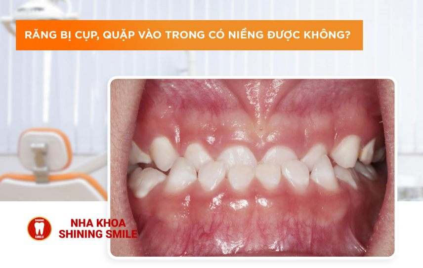 Niềng Răng Bị Cụp: Hiện Tượng Và Cách Khắc Phục