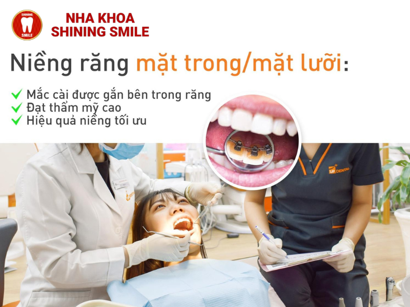Niềng răng mặt trong là gì? Ưu và nhược điểm của niềng răng mặt trong
