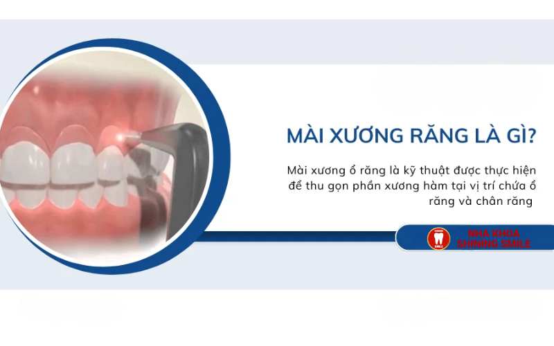 Mài Xương Ổ Răng Giá Bao Nhiêu? Cập Nhật Thông Tin Mới!