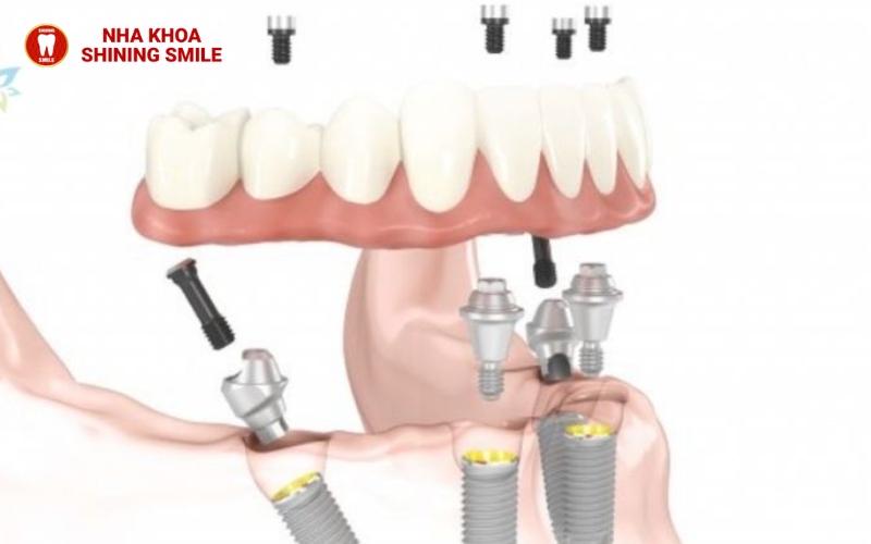 Trồng Răng Implant Bị Sưng: Nguyên Nhân Và Cách Giảm Sưng!