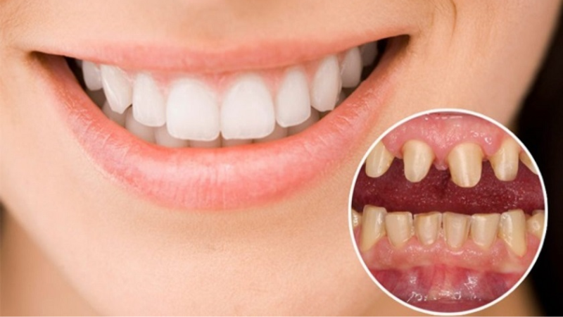 Bọc Răng Sứ Có Bị Rơi Ra Không? Sự Thật Về Độ Bền