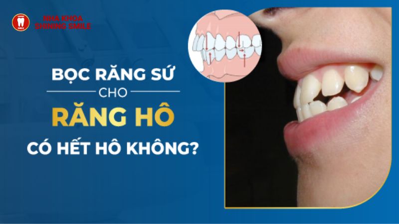 Bọc Răng Sứ Có Hết Hô Không? Tìm Hiểu Ngay