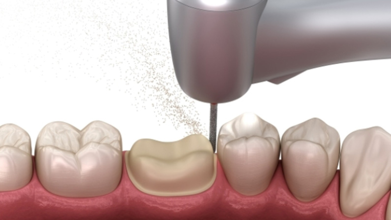 Giải Pháp Cho Tình Trạng Bọc Răng Sứ Khó Nhai