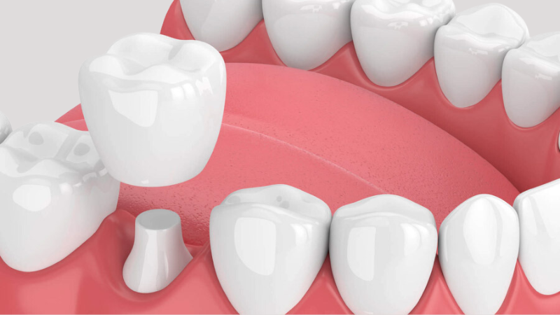 Còn Chân Răng Có Bọc Sứ Được Không? Tư Vấn Từ Bác Sĩ