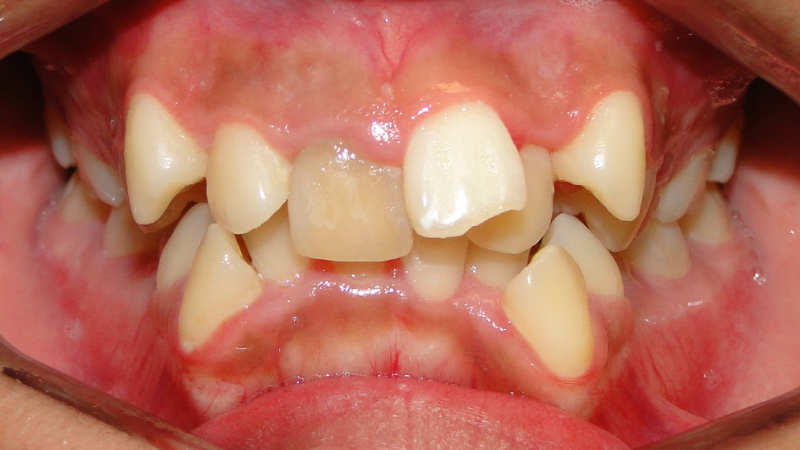 Răng Mọc Lệch Có Bọc Sứ Được Không? Lời Khuyên Từ Chuyên Gia