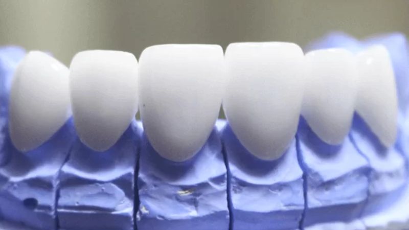Răng Sứ Ceramill: Sự Lựa Chọn Hoàn Hảo Cho Nụ Cười