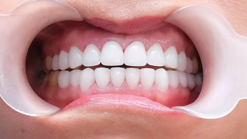 Răng Sứ Zirconia Hàn Quốc: Đột Phá Trong Công Nghệ Làm Răng