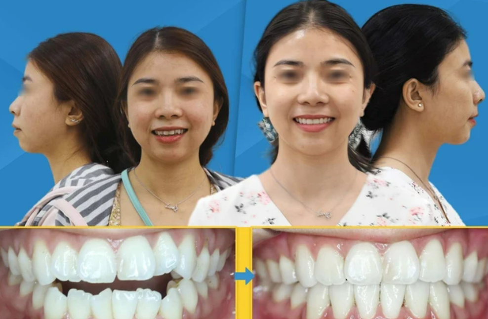 Như thế nào được coi là niềng răng thành công?