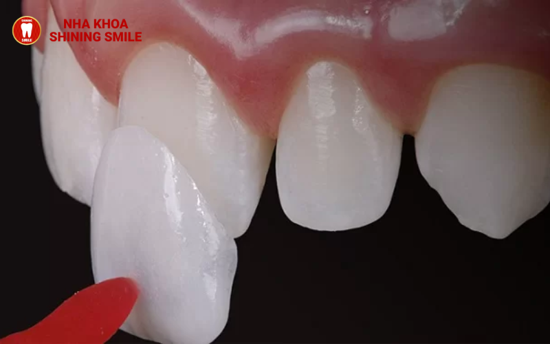 Dán Sứ Veneer: Giải Pháp Hoàn Hảo Cho Hàm Răng Đẹp Tự Nhiên