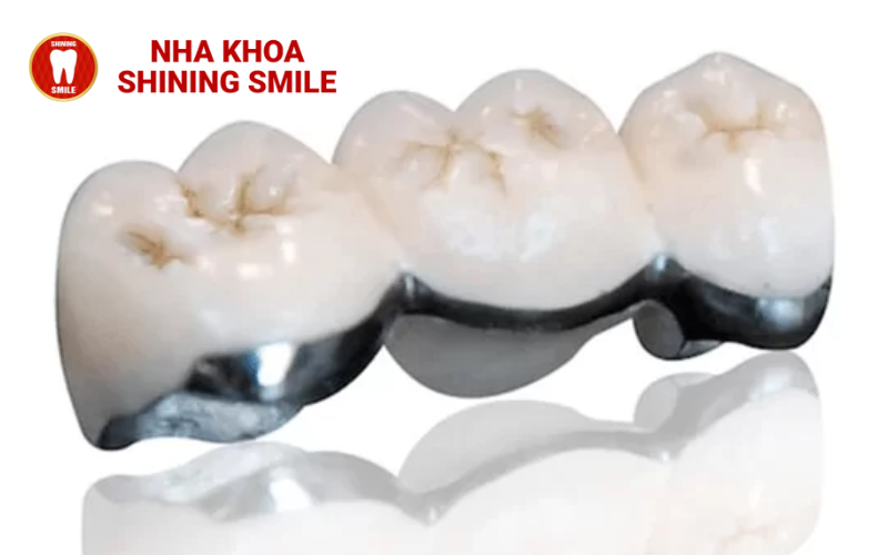 Răng Sứ Kim Loại: Ưu Và Nhược Điểm Bạn Cần Biết