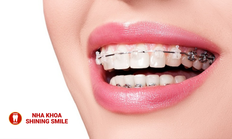 Tất Tần Tật Về Niềng Răng Cố Định: Lựa Chọn Nào Cho Bạn?