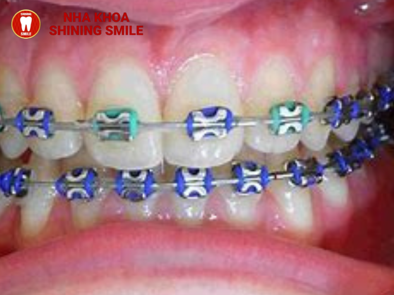 Giá niềng răng mắc cài kim loại mới nhất 2024