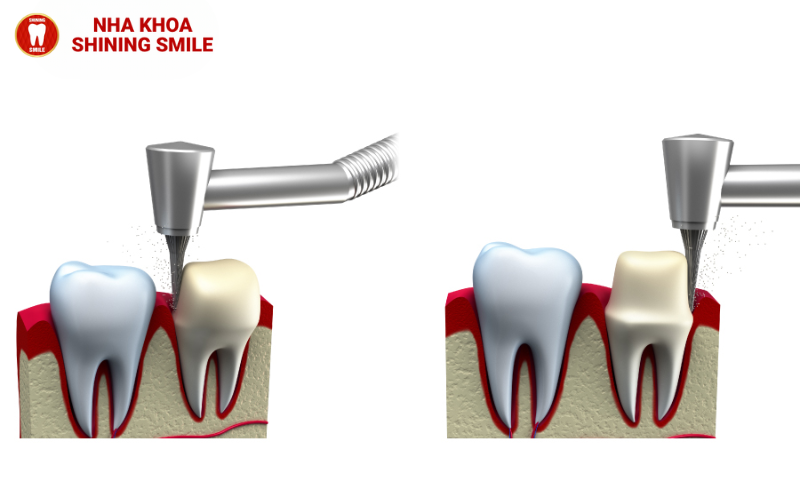 Mài Răng Bọc Sứ: Quy Trình Và Những Điều Cần Biết
