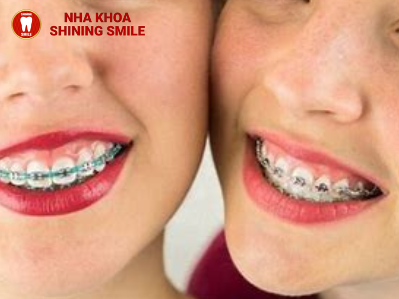 Có thể niềng răng mỗi hàm trên không?