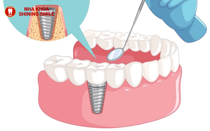60 Tuổi Có Nên Trồng Răng Không? Lời Khuyên Từ Chuyên Gia!