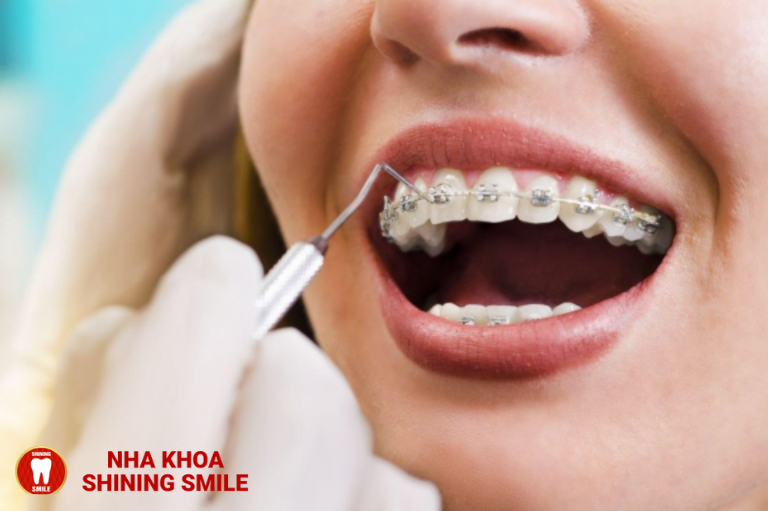 Niềng Răng và MRI: Có Thể Kết Hợp Chúng Không?