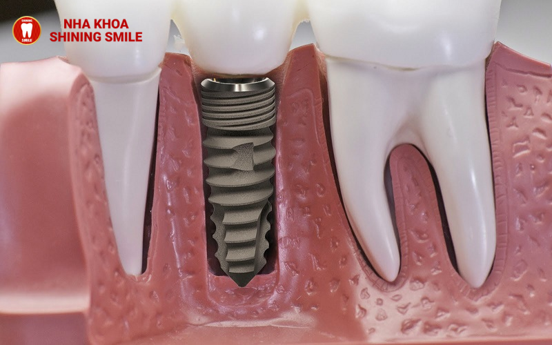Implant Là Gì? Tất Tần Tật Những Điều Bạn Cần Biết!