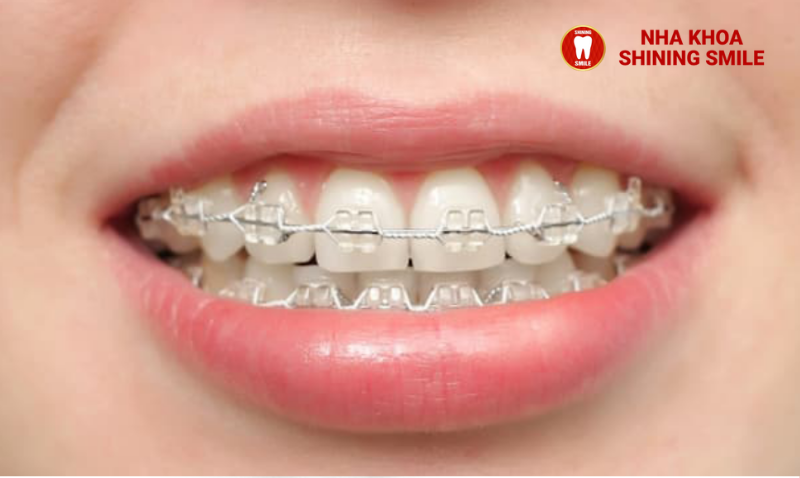 Niềng Răng Có Thể Duy Trì Vĩnh Viễn Được Không?