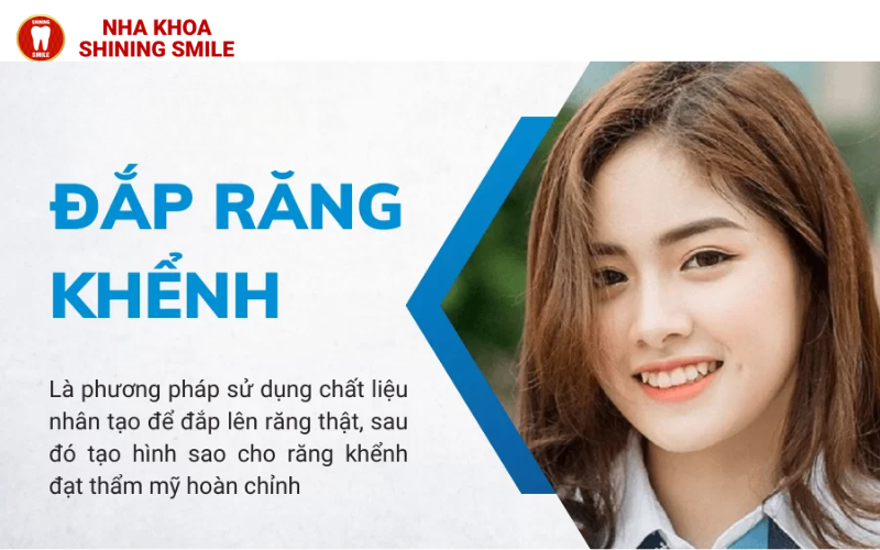 Đắp Răng Khểnh: Xu Hướng Thẩm Mỹ Nha Khoa Hiện Đại
