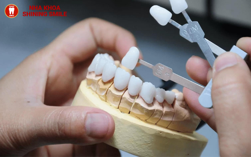 Răng Sứ Lava: Ưu Điểm Vượt Trội Và Chi Phí Thực Hiện