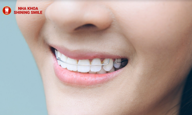 Đeo Hàm Duy Trì: Bạn Có Thể Ăn Uống Bình Thường Không?