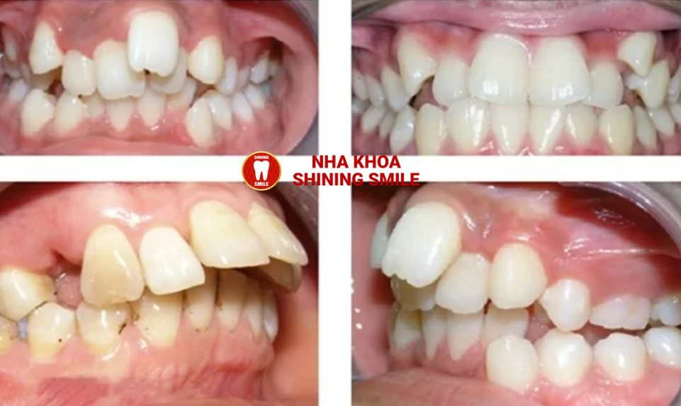 Niềng Răng Lệch Lạc Hiệu Quả Nhất