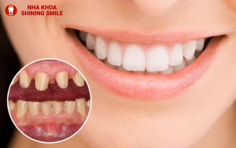 Răng Sứ Zicomax: Công Nghệ Hiện Đại Cho Nụ Cười Rạng Rỡ