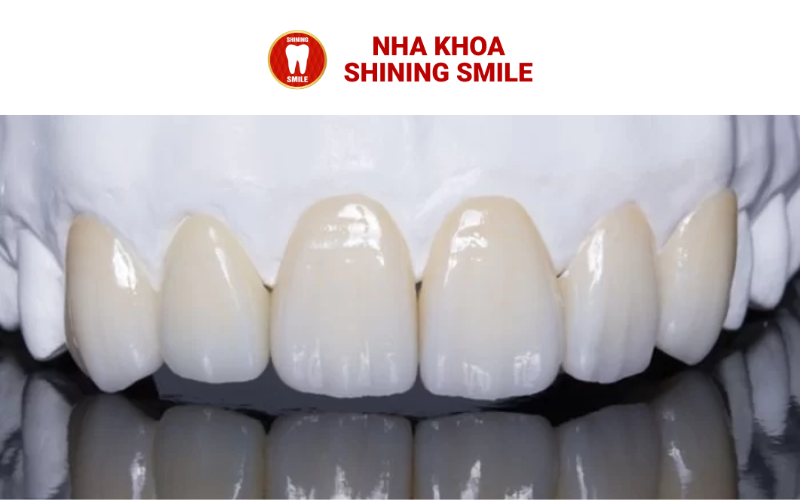 Bọc Sứ Răng Cửa: Giải Pháp Thẩm Mỹ Hoàn Hảo Cho Nụ Cười