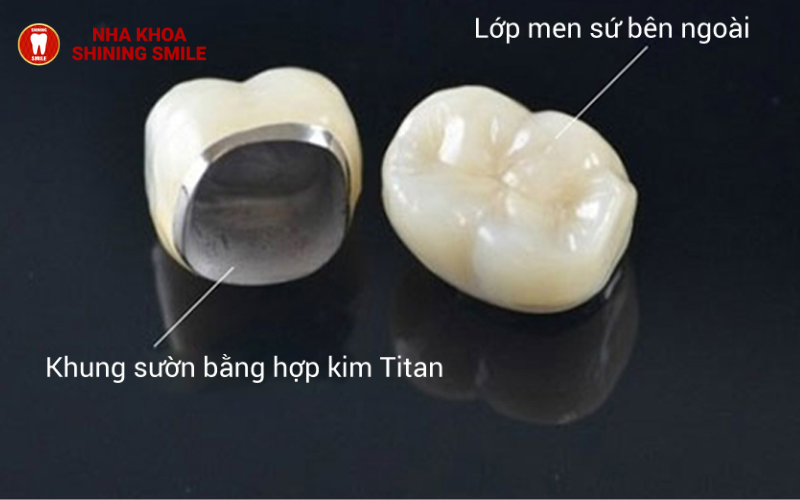 Bọc Răng Sứ Titan: Lựa Chọn Hoàn Hảo Cho Nụ Cười Rạng Rỡ