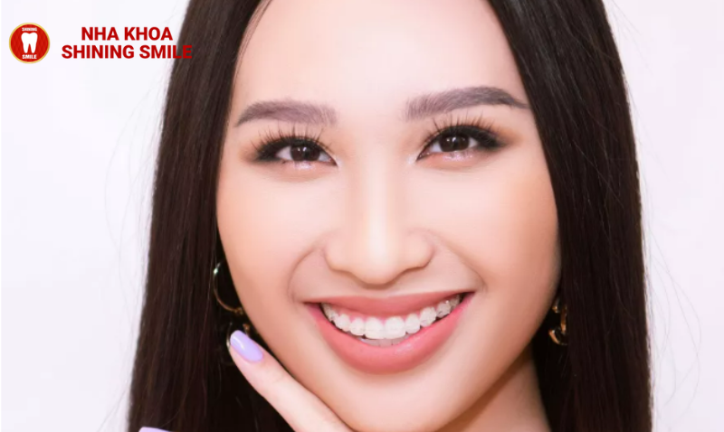 Khám Phá Mắc Cài Sapphire: Lựa Chọn Tinh Tế cho Nụ Cười Hoàn Mỹ