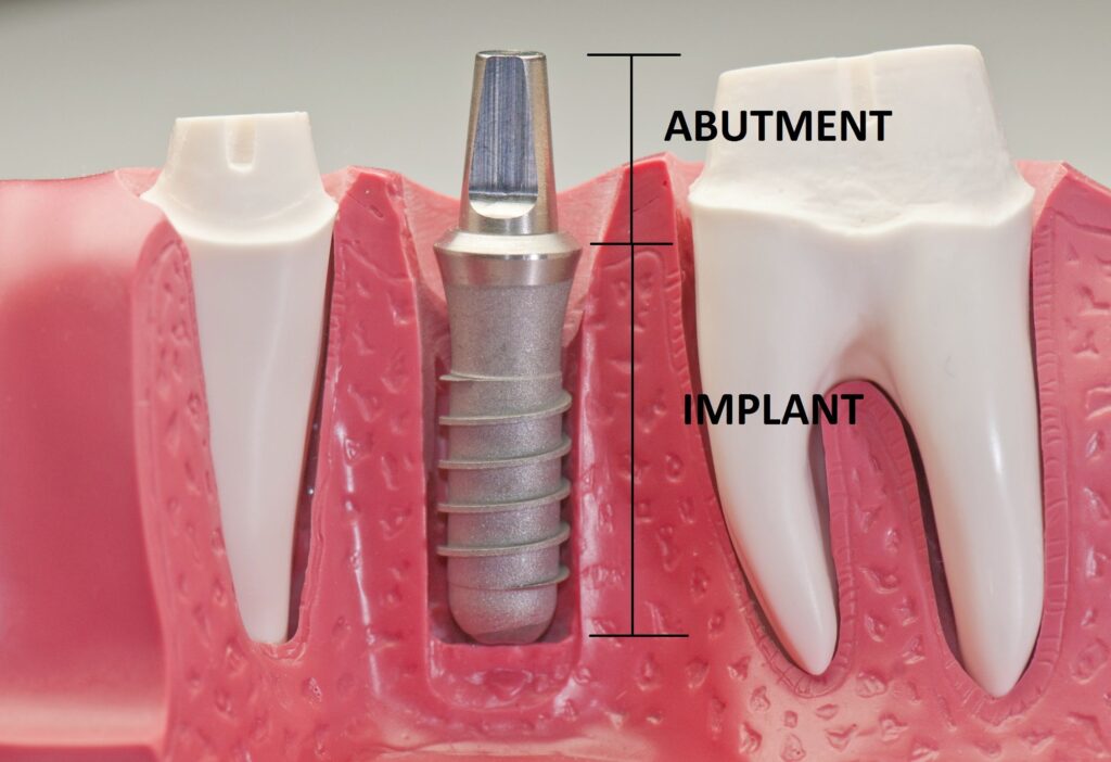 Răng Implant Bị Rớt: Nguyên Nhân Và Cách Xử Lý Hiệu Quả!