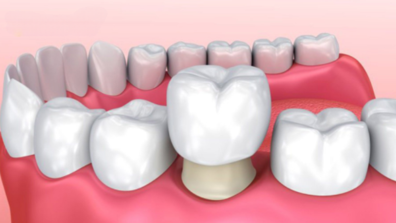 Trước Và Sau Khi Làm Răng Sứ: Những Điều Bạn Cần Biết