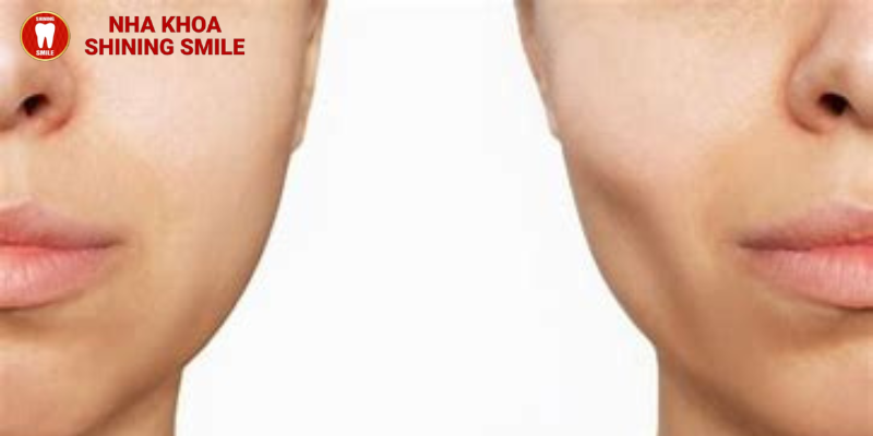 Nguyên nhân gây hóp má khi niềng răng