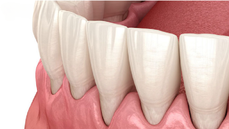 Cách Khắc Phục Tình Trạng Bọc Răng Sứ Bị Tụt Lợi