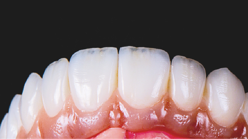 Mão Răng Sứ: Công Dụng Và Quy Trình Thực Hiện