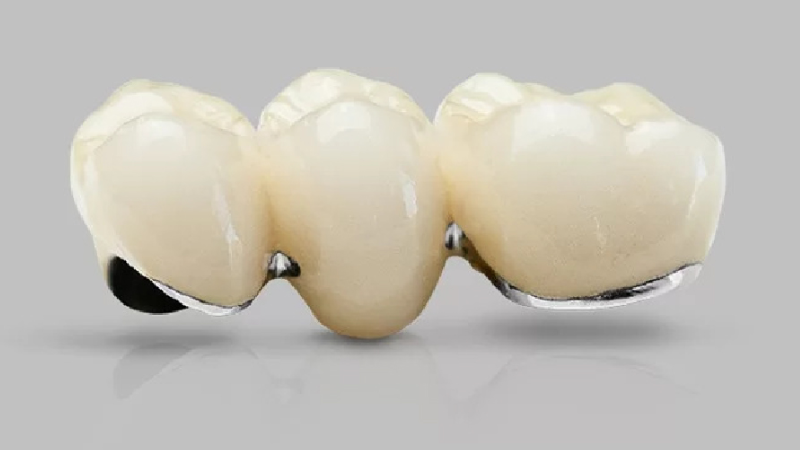 Răng Sứ Ceramco: Lựa Chọn Hoàn Hảo Cho Nụ Cười Tươi Sáng