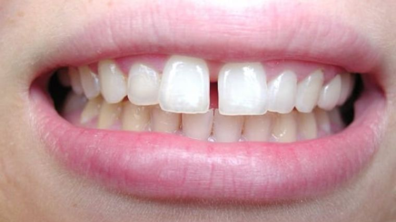 Răng Thưa Phải Làm Sao? Các Giải Pháp Hiệu Quả