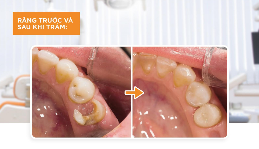 Răng Trám Có Thể Niềng Được Không? Giải Đáp Từ Chuyên Gia