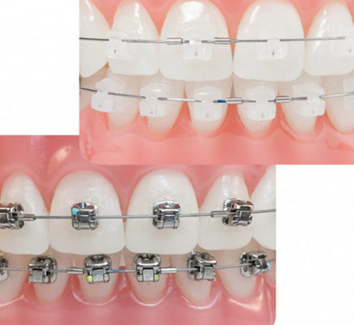 Phân Biệt Mắc Cài Pha Lê và Mắc Cài Sứ: Đâu Là Sự Lựa Chọn Tốt Hơn?